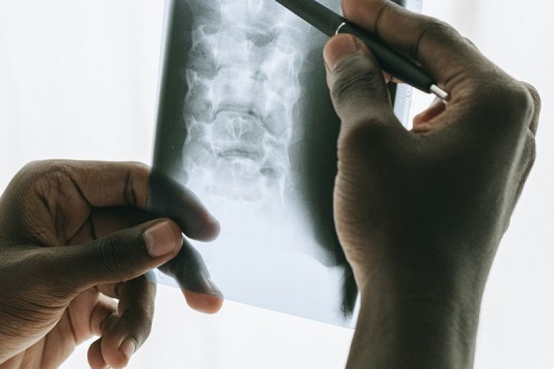 Revision Spine Surgery