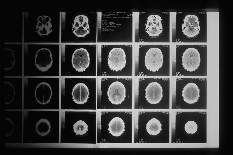 Brain Tumors